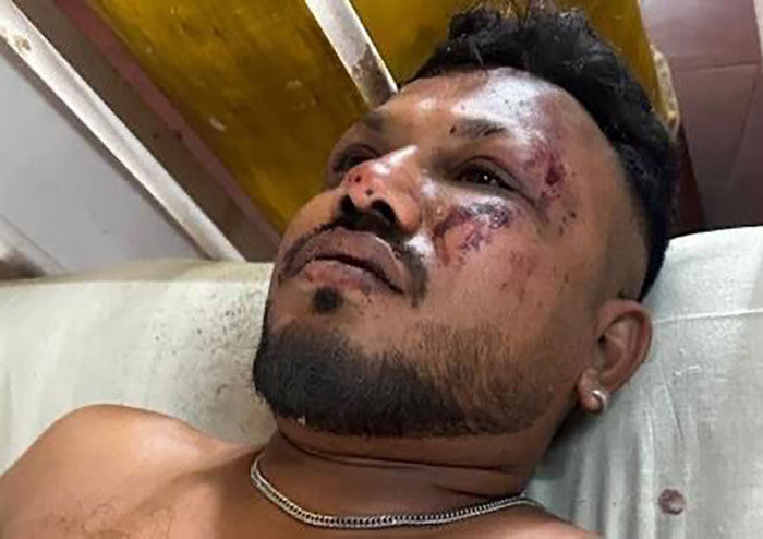El actor tailandés con lesiones faciales se encuentra en una cama de hospital después de sobrevivir a un accidente aéreo, revelando un vínculo misterioso con el sobreviviente de Air India.
