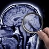 Una proteína clave llamada Reelin puede ayudar a evitar la enfermedad de Alzheimer, según un creciente cuerpo de investigación.