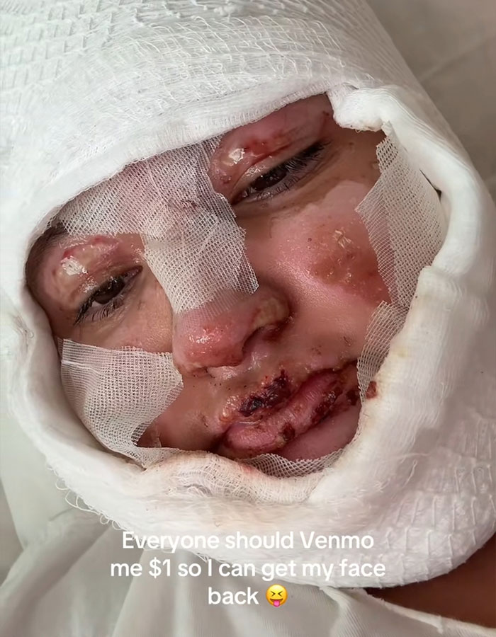 Adolescente con quemaduras faciales severas envueltas en vendas después de un accidente de S'mores que necesita asistencia de abogados de productos.