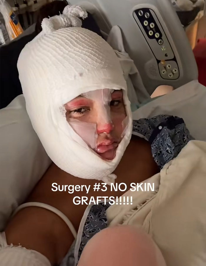 Adolescente con vendajes faciales severos que se encuentran en la cama del hospital después de un accidente de creación de s'mores causando lesiones desfigurantes.