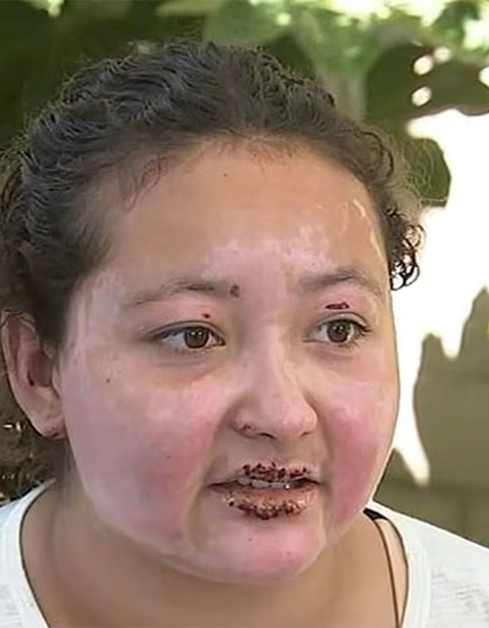 Adolescente con lesiones faciales de un accidente de creación de s'mores, destacando la necesidad de un buen abogado de productos.