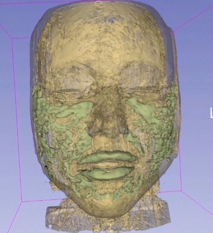 El escaneo 3D de una cara que muestra texturas desiguales, relacionadas con Love Island Face Trend y relleno preocupaciones de ceguera.