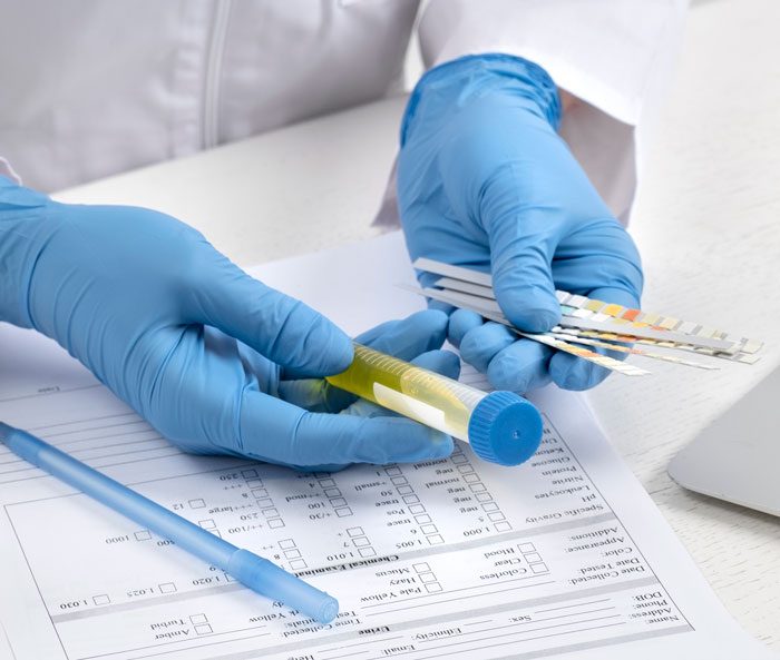Persona en guantes azules que manejan la muestra de orina y las tiras de prueba, que ilustra el análisis de resultados mixtos de prueba de ADN.