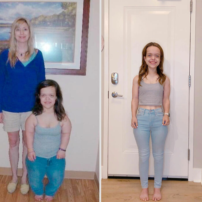 Mujer de 31 años con enano antes y después de la cirugía de altura, mostrando una transformación impresionante y una mayor altura en interiores.