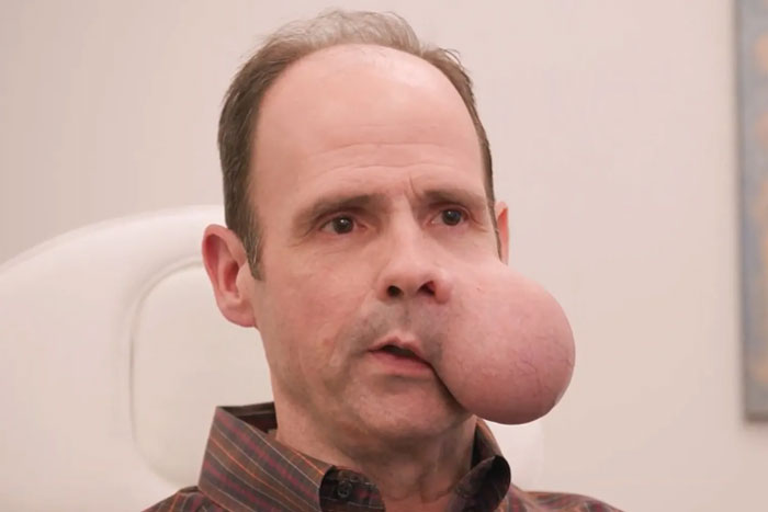 Hombre con un gran tumor facial de 4 libras sentado en el interior, buscando ayuda médica urgente mientras el médico emite una advertencia fatal.