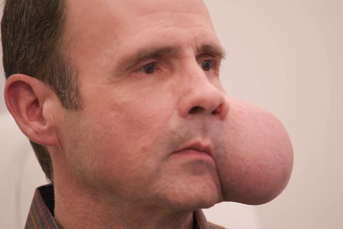 Un hombre con un gran tumor facial de 4 libras en la mejilla busca ayuda médica urgente en medio de una advertencia médica fatal.