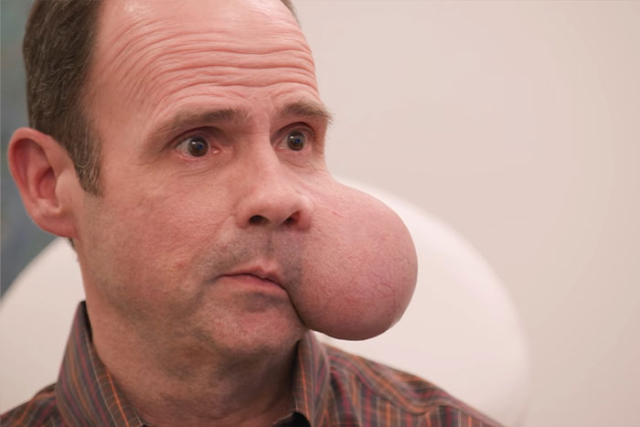 Hombre con un gran tumor facial de 4 libras sentado en un consultorio médico buscando ayuda urgente después de que el médico emitiera una advertencia fatal.