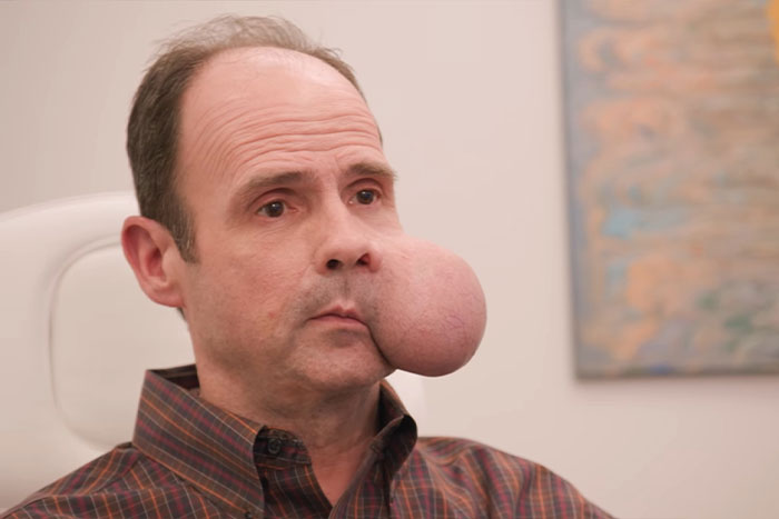 Un hombre con un gran tumor facial de 4 libras sentado en el interior buscando ayuda médica urgente en medio de una advertencia médica fatal.