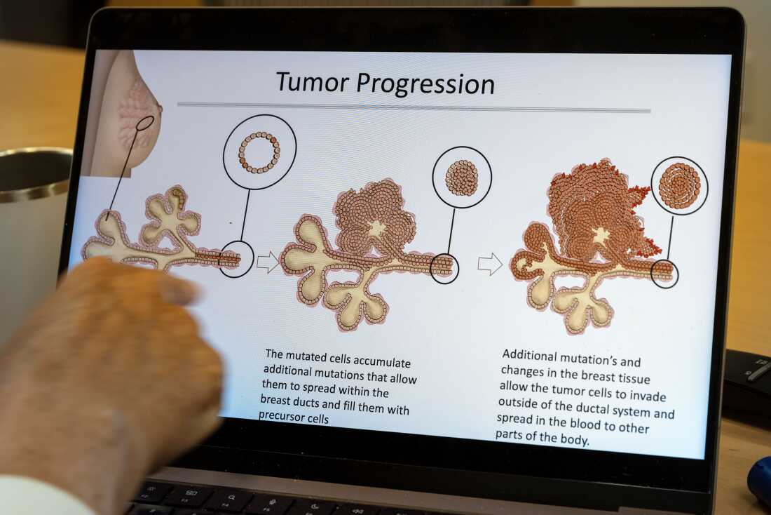 Un gráfico en la pantalla de una computadora portátil muestra los tres pasos de la progresión del tumor de mama. El dedo de Joan Brugge señala el gráfico mientras explica los pasos.